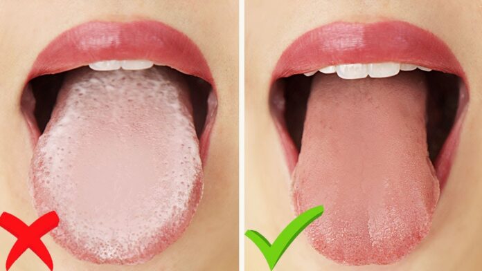 white coating on tongue