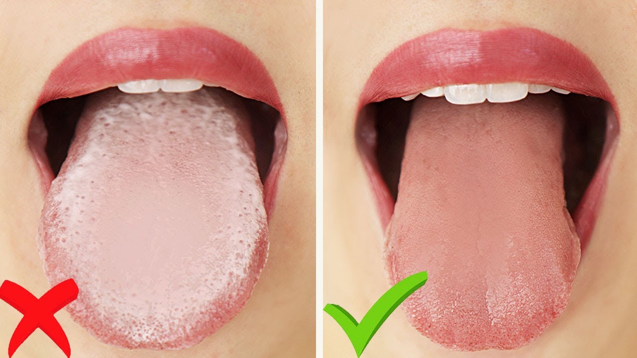 White Coating On Tongue White Coating On Tonguewhite Coating On Tongue