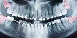 When Do Wisdom Teeth Come In Fully Grow In When Do Wisdom Teeth Come In