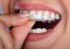 Dental Decoded: 3 Tips To Maintain And Care For Your Aligners Care For Aligners